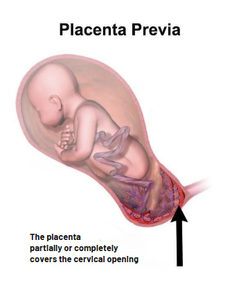 "Placenta previa". illustration of fetus in womb. an arrow points to the cervical opening, which is blocked by the placenta. "The placenta partially or completely covers the cervical opening."