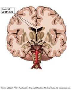 Infant Intracranial Hemorrhages (Brain Bleeds): Signs, Symptoms, Causes ...