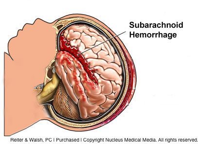 What is a Subarachnoid Hemorrhage (SAH)?