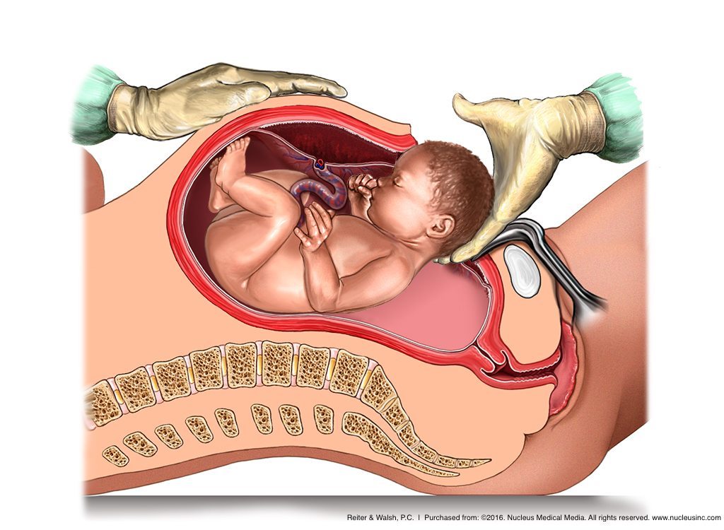 fetus being delivered by C-section