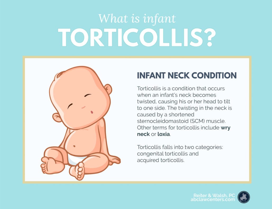 https://www.abclawcenters.com/wp-content/uploads/2023/11/Infant-Torticollis-1030x792-1.jpg