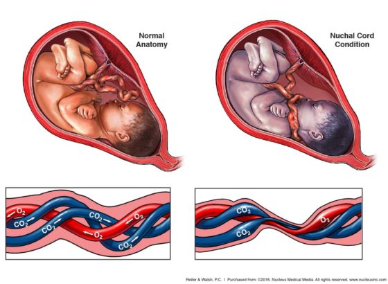 Umbilical Cord Complications: Things You Did Not Know About